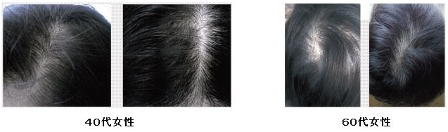 薬用育毛剤【Wアプローチヘア】の発毛効果